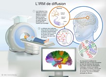 L'imagerie par résonance magnétique (IRM) de diffusion