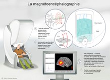 ​La magnétoencéphalographie